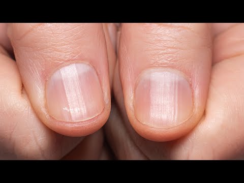 Are Ridges in Nails a Sign of Hypothyroidism? | Paloma Health
