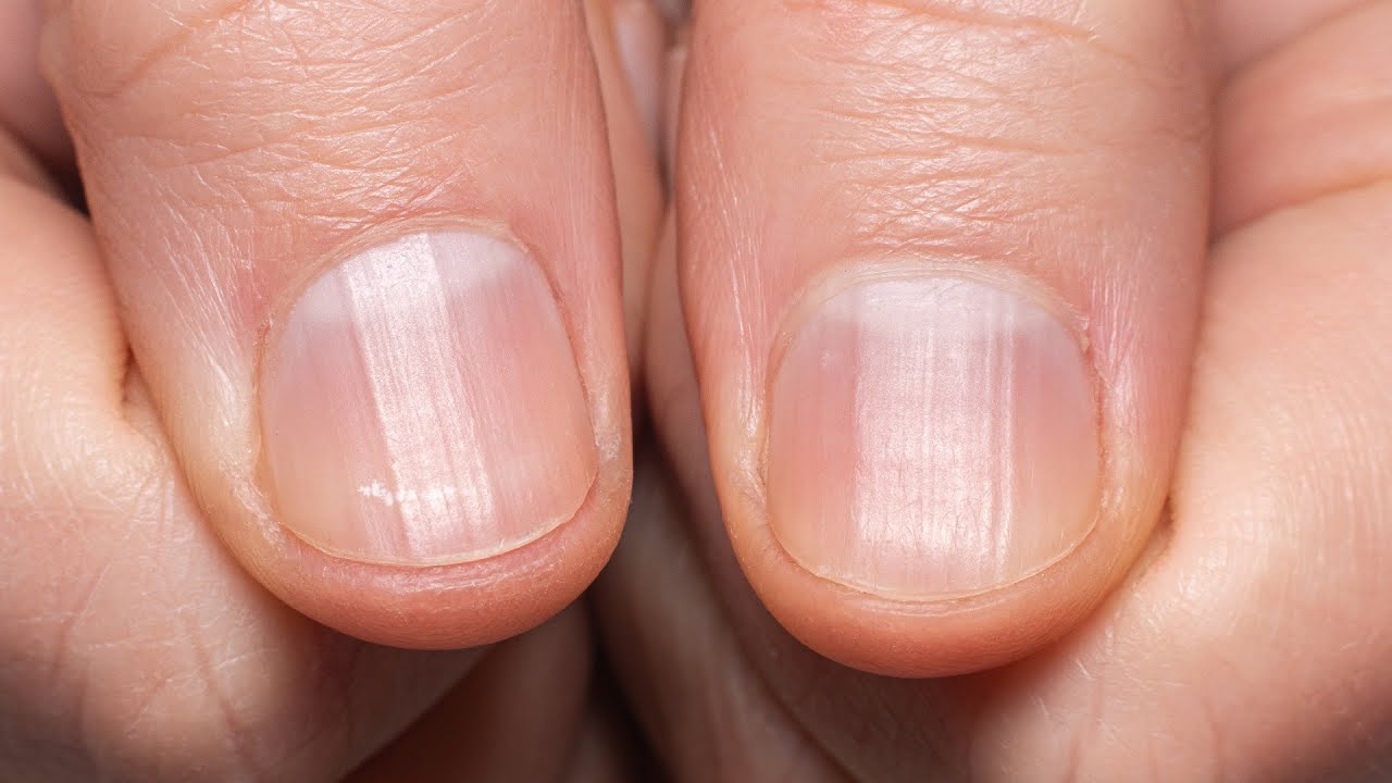 Red and white stripes on my nails : r/calmhands