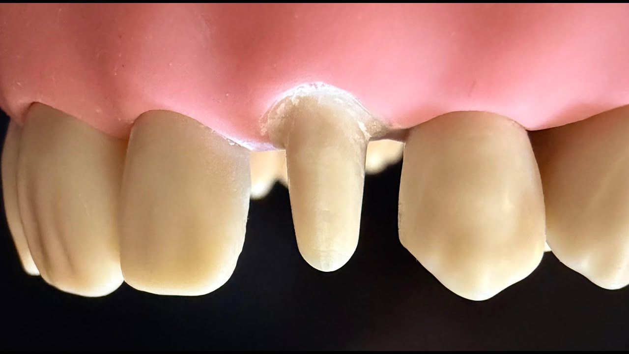 TP préparation pour canine maxillaire