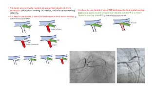 Left main trifurcation strategies