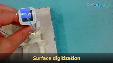 Pedicle screw navigation using surface digitization on the Microsoft HoloLens