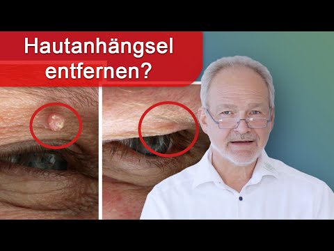 Fibrome, Warzen, auch