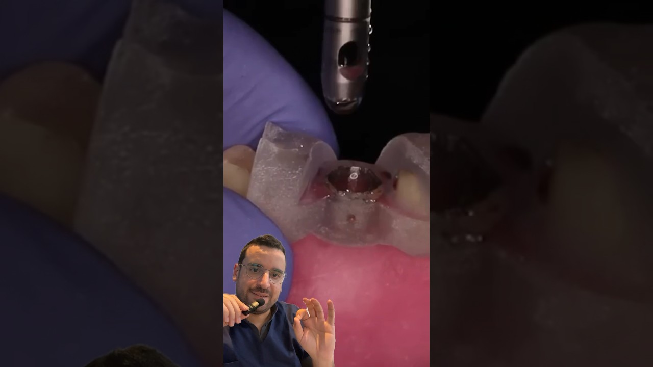 Pose d’IMPLANT dentaire avec GUIDE implantaire