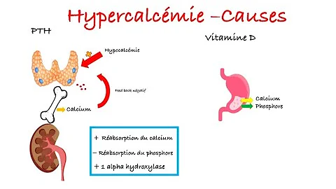 Qu'est-ce que l'hypercalciurie ?