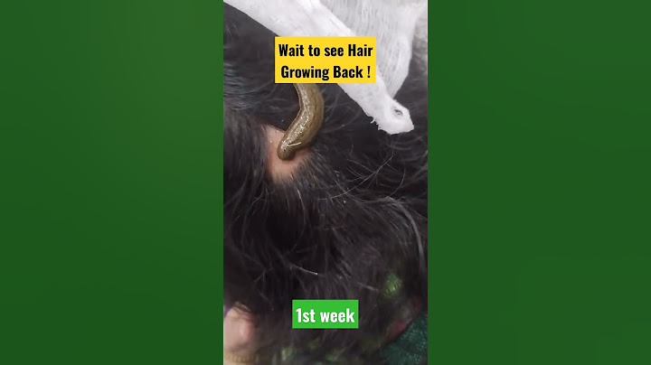 Hair Growing Back on Bald Patch !