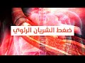 Pulmonary Artery Hypertension ارتفاع ضغط الشريان الرئوي