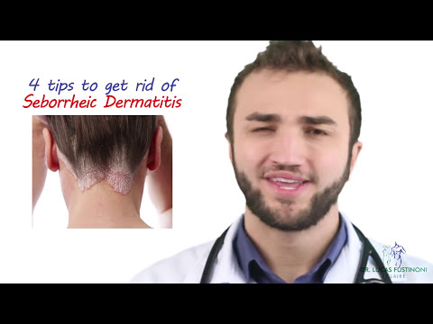 4 Tips to Get Rid of Seborrheic Dermatitis - Dr Lucas Fustinoni Brasil