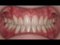 Before and After Photos of Braces, Clear Braces, and Invisalign Patients Treated by Dr. Collins