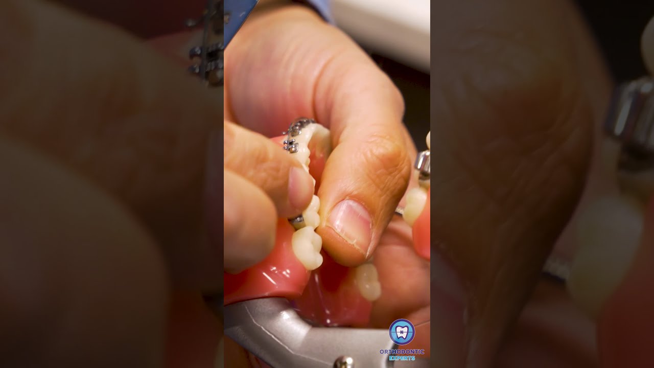 Braces Emergencies | Loose Band | #Shorts