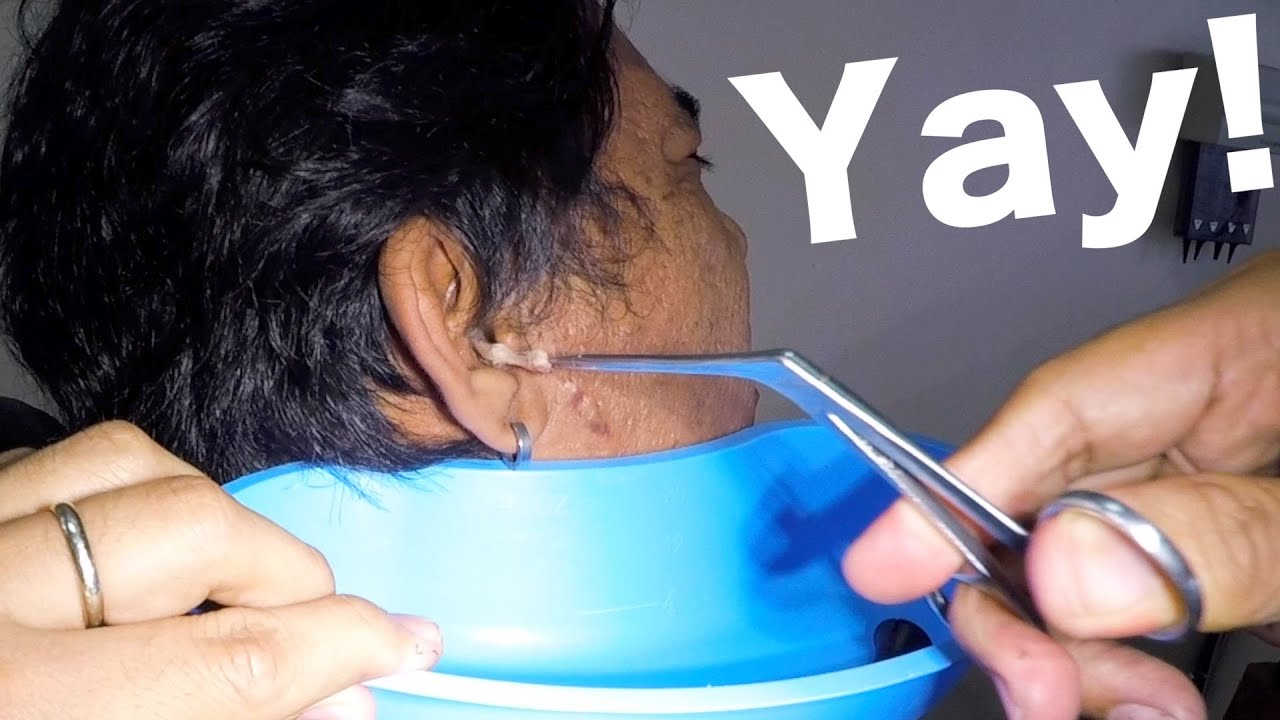 Cotton Balls Stuck for Days in Man's Ear Removed YouTube