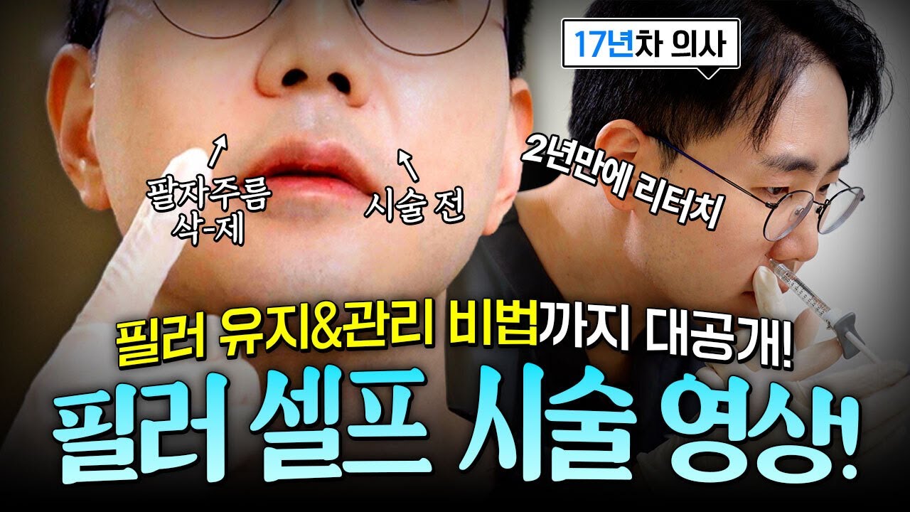 필러 셀프 시술 영상! 천안필러 김영권 원장이 본인에게 직접 하는 안전한 필러 시술법