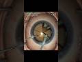 PHACO SURGERY 3D