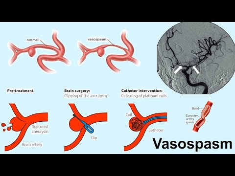 Video: Co znamená vazospastika?