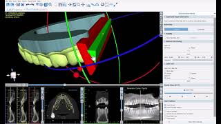 BSP V4.13: Design and Export Aligners for Direct Aligner Printing