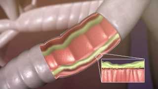 Aerobika* OPEP Device - How It Works - Trudell Medical International Aerobika* OPEP Device - How It Works - Trudell Medical International