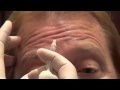 Botox Training - Forehead Injections - Empire Medical Training