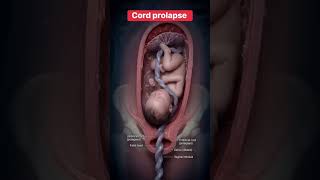 Cord prolapse: The life-threatening obstetric emergency