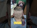 اخفاء اثار عملية زراعة الشعر ب 