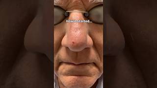 If not skin cancer, this is how dermatologists get rid of red spots #shorts