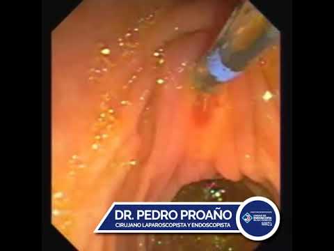 CPRE (Colangiopancreatografia Retrógrada Endoscópica)