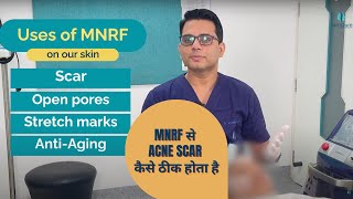 MNRF Laser for Acne Scars  | Best treatment for Acne scar | SkinQure | Dr. Jangid