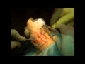 Hallux Valgus (Bunion) Correction - Scarf Osteotomy - YouTube