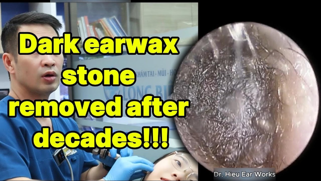 Ear Rocks Treatment Dark earwax stone removed after decades | ear cleaning | ASMR earwax ...