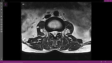 O que é neurofibromatose Plexiforme?