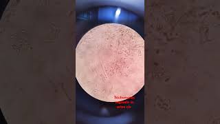 urine R/e slide Trichomonas vaginalis # lab technician # Khalid
