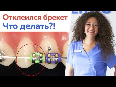 Что делать, если отклеился брекет? / Можно ли подтягивать брекеты самостоятельно?