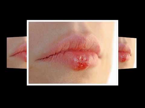 ★입술에 찬 상처를 제거하는 법. 헤르페스 바이러스를 치료하는 방법. 입술에 감기