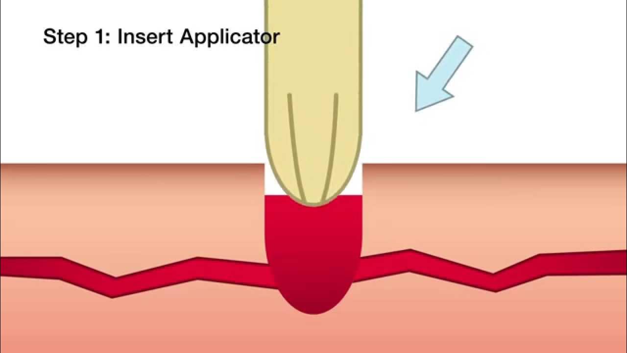 Celox A Applicator Hemostatic Plunger Training YouTube