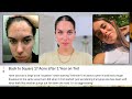 ONE YEAR ON TRETINOIN! STILL BREAKING OUT?? HYPERPIGMENTATION UPDATES, GLOWING SKIN | Rudi Berry