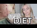 Curing My Hormonal Cystic Acne | My Acne Diet | All Natural, No Accutane | DAIRY + GLUTEN