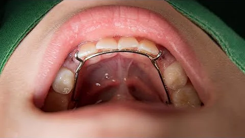 Lower Lingual Holding Arch for a YOUNG Patient - Getting Braces in Texas