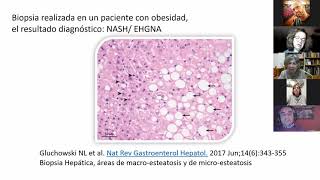 Sesión 3 Paciente Experto. Enfermedad hepática por hígado graso desde el punto de vista del paciente