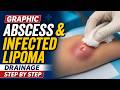 Graphic Abscess &amp; Infected Lipoma Drainage Step by Step