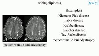 sphingolipidosis