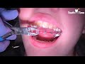 Braces Off - Tooth Time Family Dentistry New Braunfels