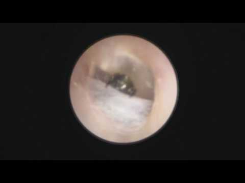 Βίντεο: Τραυματισμοί στο αυτί στην Τσιντσιλά