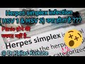 Herpes simplex hsv 1  hsv 2 infection    