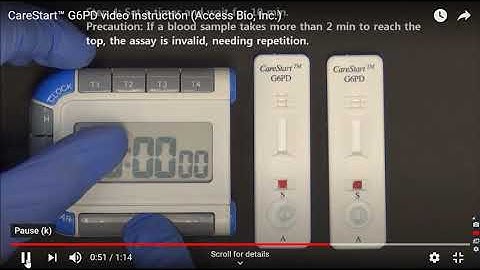 Using G6PD Carestart RDT