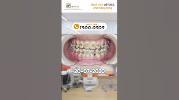 Hành trình LỘT XÁC nhờ niềng răng của khách hàng Khánh Nghi