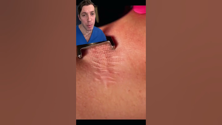 How CO2 Lasers Can Help Smooth Your Skin
