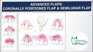 ADVANCED (PEDICLE) FLAPS| CORONALLY POSITIONED FLAP| SEMILUNAR FLAP| ROOT COVERAGE| DR. ANKITA