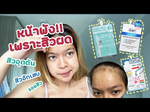 รีวิวยาแต้มสิวเซเว่น สามตัวสุดปัง! Clear Nose,Yanhee Acne Cream,Rojukiss Acne Spotless Serum