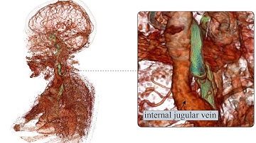 Visualizing Carotid Blood Flow Simulations for Stroke Prevention