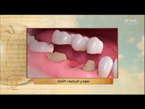 الحكيم في بيتك د هيثم عمرو يوضح مفهوم التركيبات الثابتة في الأسنان