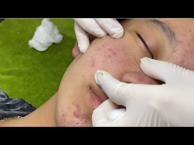 Acne treatment under the skin #017