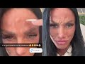 Katie Price reveals concerning HUMPS on her forehead following Botox injections